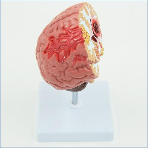 仿真人体脑部疾病模型大脑结构解剖神经内科医用学生教学模型